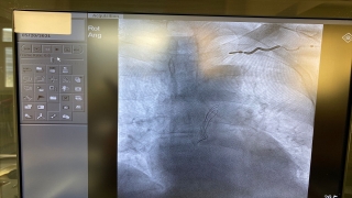 Aydın’da bir hastanın enfeksiyona neden olan kalp pili kablosu, hassas operasyonla çıkarıldı